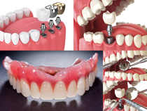 3D建模中植牙摄影高清图片